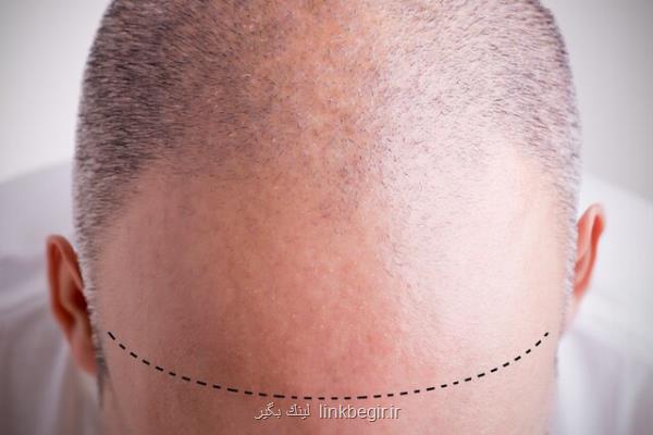 پیشگیری از ریزش مو با مسدود كردن انقباضات غلاف پوستی
