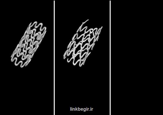 ابداع استنت قابل تجزیه زیستی برای باز نگه داشتن راه هوایی كودكان